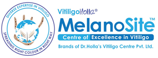 Vitiligo Holla Treatments For Vitiligo