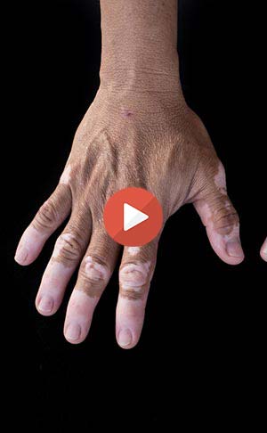 Vitiligo on fingers